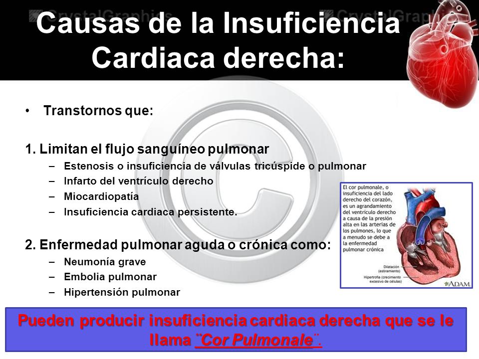 ¿Puede la hipertensión arterial pulmonar causar insuficiencia cardíaca?